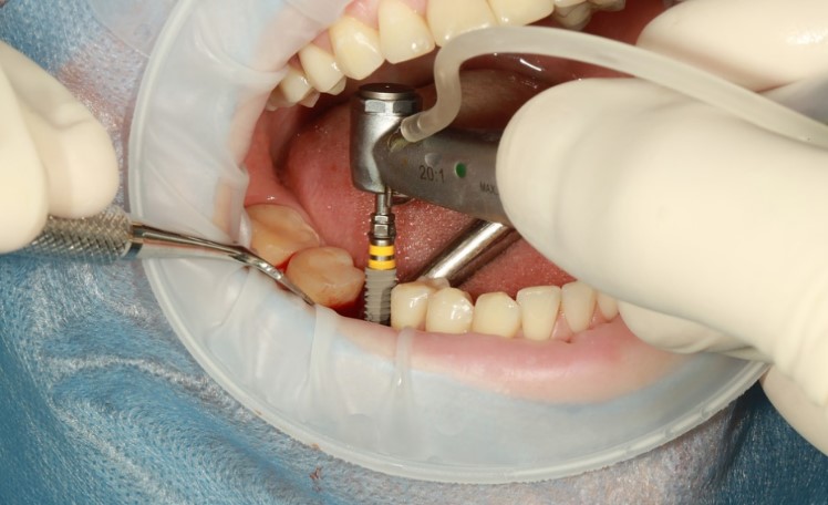 Insights on Digital Dental Implants
