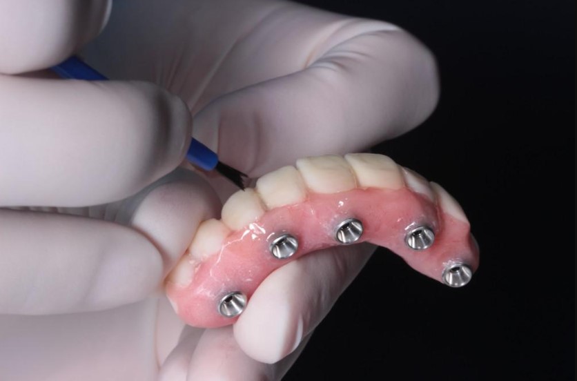 All On 4 Dental Implants: 4 Things You May Not Know About Them